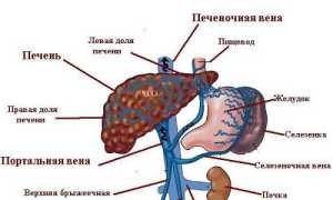 Тромбоз печёночных вен (синдром Бадда-Киари): причины и лечение