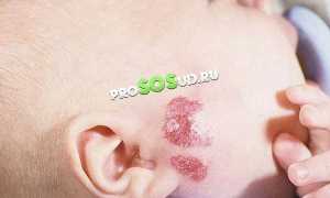 Причины возникновения и лечение гемангиомы у детей: важные аспекты