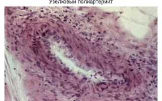 Классификация и лечение системных васкулитов: основные аспекты и рекомендации
