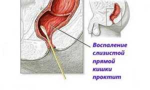 Лечение проктита свечами: перечень эффективных суппозиториев