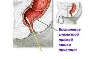 Лечение проктита свечами: перечень эффективных суппозиториев