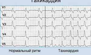 Что такое синусовая тахикардия сердца и её причины