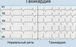 Что такое синусовая тахикардия сердца и её причины