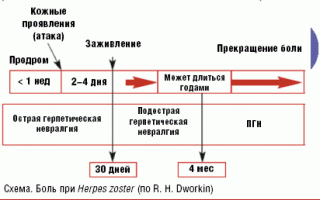 Постгерпетическая невралгия: причины, признаки, симптомы и лечение
