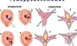 Что такое геморроидэктомия? Подготовка, последствия и реабилитация после операции