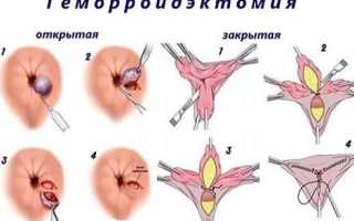 Что такое геморроидэктомия? Подготовка, последствия и реабилитация после операции