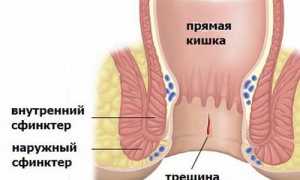 В чем отличие анальных трещин от геморроя, в чем их связь и как это всё лечить?