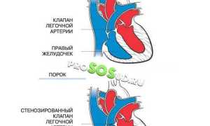Стеноз легочной артерии: лечение, профилактика, диагностика и рекомендации