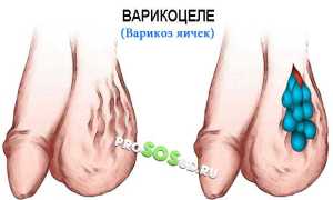 Какие могут быть последствия варикозного расширения вен на яичка у мужчин: лечение, симптомы и профилактика