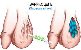 Какие могут быть последствия варикозного расширения вен на яичка у мужчин: лечение, симптомы и профилактика