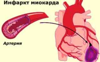 Тромболитическая терапия: современные подходы и методы