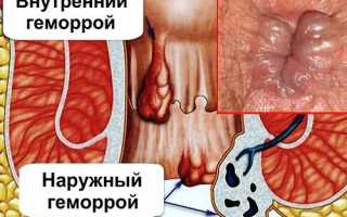 Как бороться с геморроем после кесарева сечения?