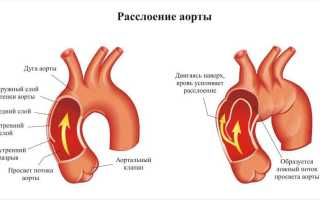 Разрыв аорты: причины, симптомы и лечение, важные аспекты