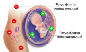 Гемолитическая болезнь у новорожденных детей: причины и лечение