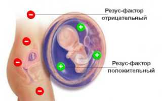 Гемолитическая болезнь у новорожденных детей: причины и лечение