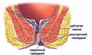 Причины появления геморроя