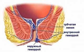 Причины появления геморроя