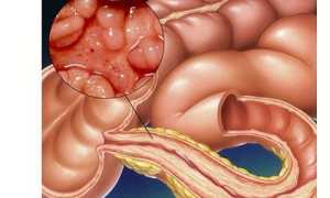 Как лечить болезнь Крона и можно ли вылечить патологию?