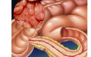 Что такое болезнь Крона, каковы причины появления патологии и её симптомы?