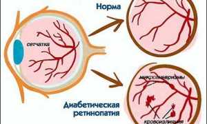 Лечение ангиопатии сетчатки обоих глаз: методы и рекомендации