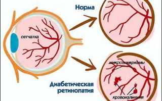 Лечение ангиопатии сетчатки обоих глаз: методы и рекомендации