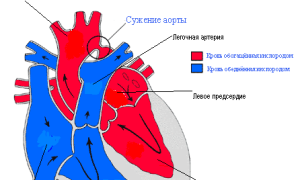 Коарктация аорты (Сужение) — причины и лечение