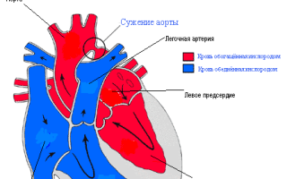 Коарктация аорты (Сужение) — причины и лечение