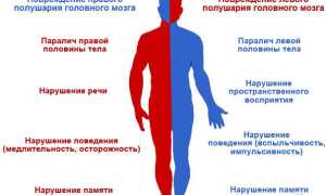 Паралич правой стороны тела после инсульта: причины и последствия