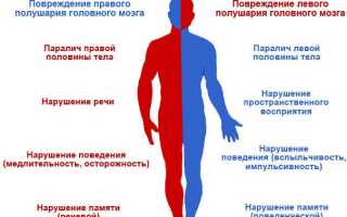Паралич правой стороны тела после инсульта: причины и последствия