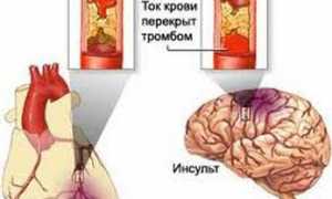 Микроинсульт: симптомы и первые признаки, которые важно знать