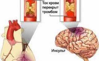 Микроинсульт: симптомы и первые признаки, которые важно знать