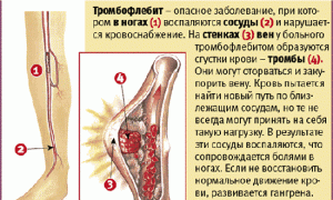 Лечение тромбофлебита вен нижних конечностей: методы и рекомендации