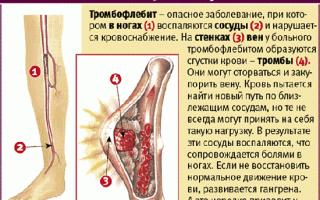 Лечение тромбофлебита вен нижних конечностей: методы и рекомендации