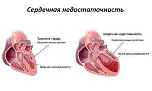 Сердечная одышка: как распознать и чем лечить в домашних условиях