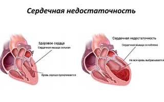 Сердечная одышка: как распознать и чем лечить в домашних условиях