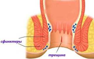 Что такое анальная трещина, каковы причины появления, симптомы и как её лечить?