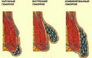 Что такое комбинированный или смешанный геморрой?