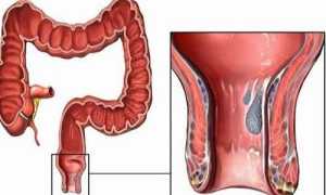 Особенности кала при геморрое: цвет, форма, включения