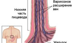 Лечение варикозного расширения вен пищевода: методы и рекомендации