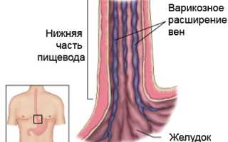 Лечение варикозного расширения вен пищевода: методы и рекомендации