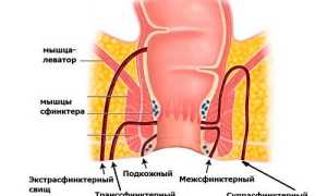 Свищ прямой кишки — что это такое?