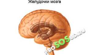 Гидроцефалия головного мозга: описание патологии, причины и лечение для пациентов