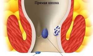 Какие могут быть последствия геморроя и осложнения у мужчин и женщин?