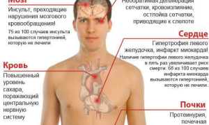 Лечение и классификация гипертонии: важные аспекты и рекомендации