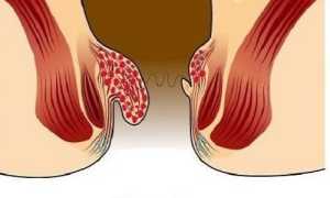 Причины перехода геморроя на 2 стадию и лечение патологии второй степени