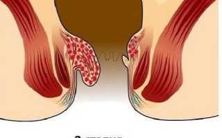 Причины перехода геморроя на 2 стадию и лечение патологии второй степени