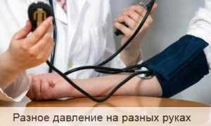 Что означает разное давление на руках и его влияние