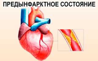 Что нужно знать о предынфарктном состоянии для сохранения здоровья