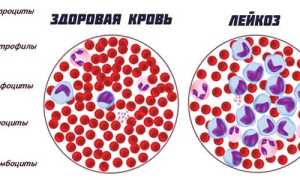 Особенности хронического лейкоза и прогноз для пациентов