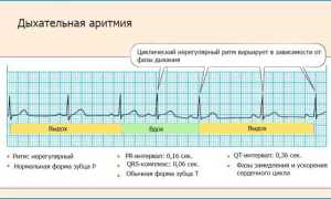 Что такое дыхательная аритмия и чем опасна для здоровья